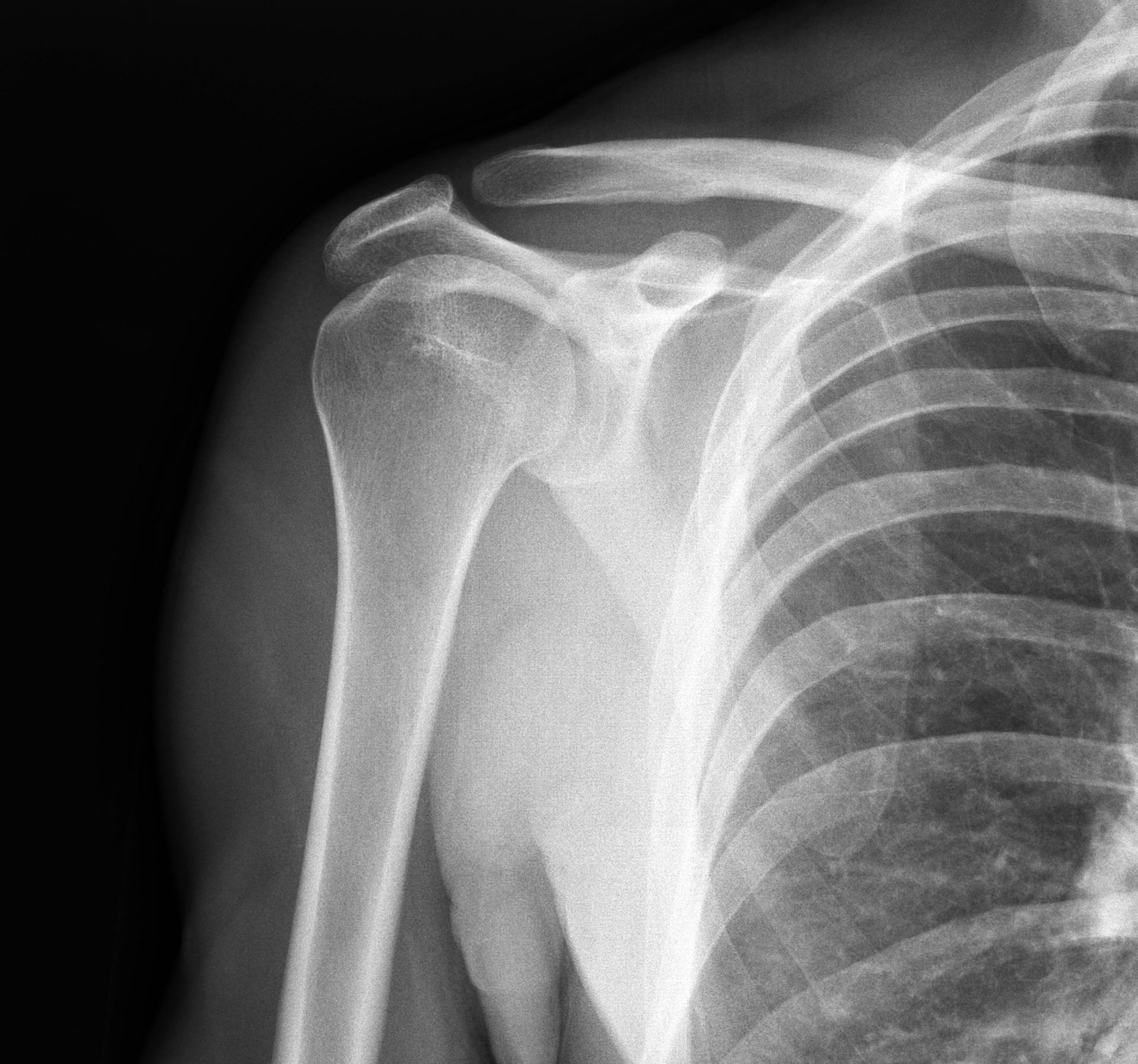 Xray of shoulder joint. Irvings Law